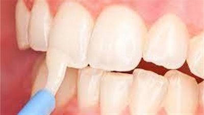 الطريقة الجديدة لترميم الأسنان