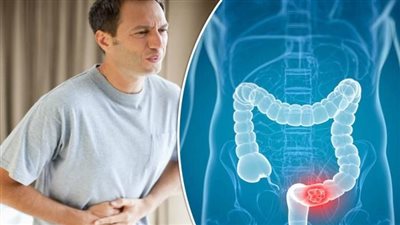 أعراض سرطان القولون