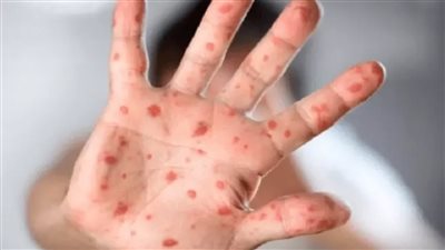 أدلة تكشف مفاجأة بشأن الإصابة بجدري القردة