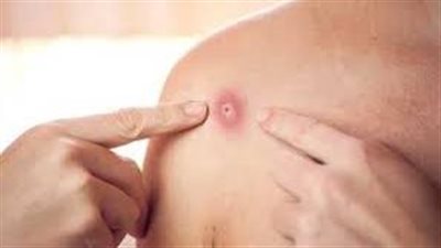 مسؤول صحي كبير في الصين يقدم نصيحة المواطنين لمنع الإصابة بجدري القرود