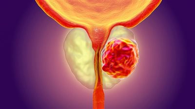 أعراض انتشار سرطان البروستاتا