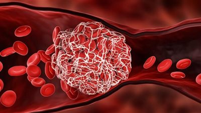 أحذر.. أطعمة تساهم في تراكم الترسبات في الشرايين