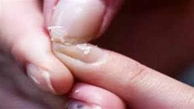  أعراض نقص الحديد 