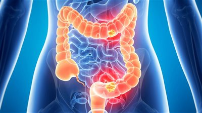 الفرق بين أعراض سرطان القولون والقولون العصبي