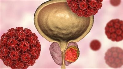 مراحل سرطان البروستاتا