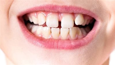 باحثون: صرير الأسنان يهاجم الأطفال أيضا وليس البالغين فقط.