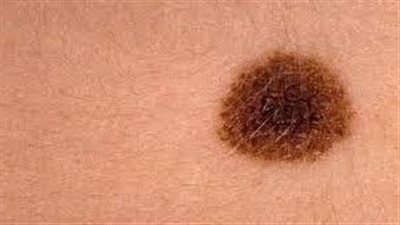 أحذر.. التغيرات الطارئة على شكل وحجم ولون الشامة تدق ناقوس الخطر