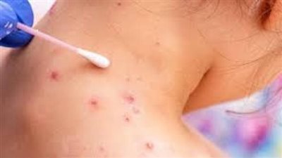  السلطات الصحية في مدينة هوشي منه الفيتنامية تعلن تسجيل أول إصابة بجدري القرود