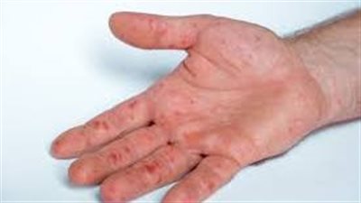  التغيرات التي تحصل في الجلد وتشير إلى أمراض السرطان والسكري وتليف الكبد