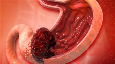 سرطان المعدة.. أكثر أنواع السرطان شيوعا وفتكا حول العالم