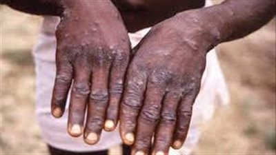 تباطؤ طفيف في انتشار فيروس 