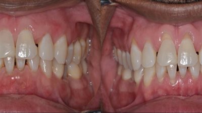 الكشف العوامل التي تؤدي لانحسار اللثة