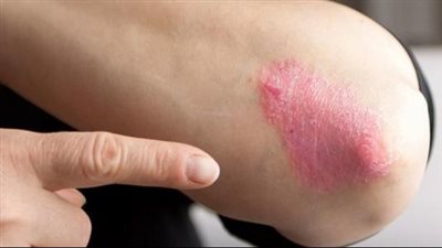 الرابطة الألمانية للأمراض الجلدية تكشف عن أعراض الصدفية