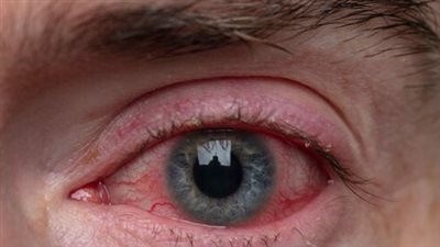 أسباب وأعراض احمرار العين.. ومتى تستوجب استشارة الطبيب؟