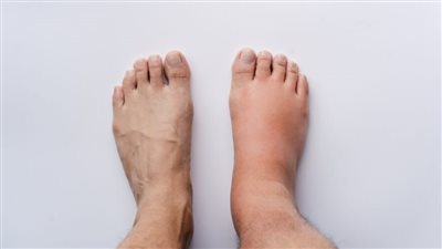 أبرزها السمنة والإجهاد البدني.. أسباب لا تعرفها بشأن تورم الكاحل