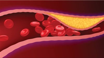 باحثون: تجلط الدم يشكل رد فعل على إصابة ما لوقف الجسم عن النزف