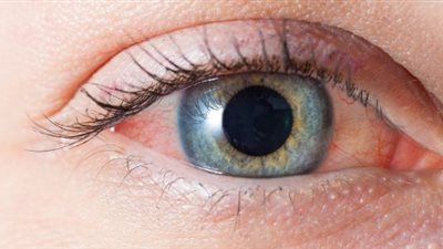 أسباب احمرار العين.. ومتى يجيب الذهاب للطبيب