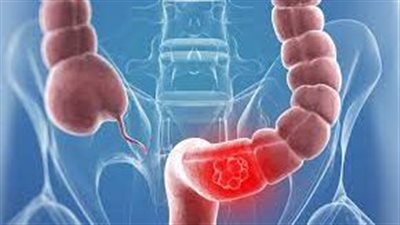 عوامل تؤدي إلى سرطان الأمعاء والقولون