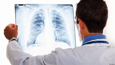 خبيرة تكشف ما يسبب التهاب الشعب الهوائية المزمن وحتى العقم