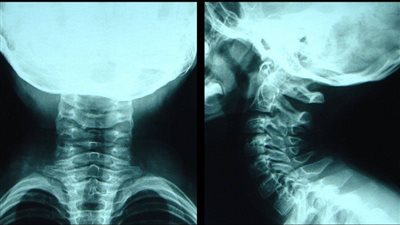  اضطراب نادر للغاية يحول العضلات والأوتار والأربطة تدريجيا إلى عظام