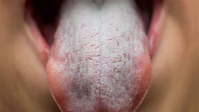 طبيبي روسي يكشف عن أسباب جفاف الفم الشديد