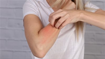 طريقة جديدة لعلاج الحساسية باستخدام خلايا مناعية معينة