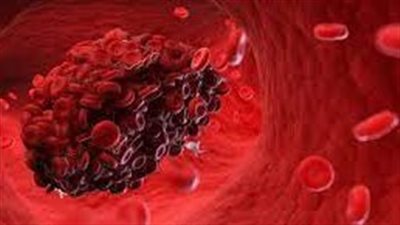 كيفية معالجة أعراض جلطة الدم