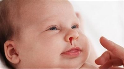 أهم أسباب نزيف الأنف لدى الأطفال