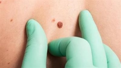 دراسة جديدة تكشف عن عوامل تساعد في محاربة السرطان