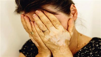 أسباب مرض البهاق.. 8 عوامل محفزة وصبغة الميلانين هي كلمة السر