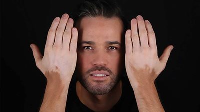 ما هو الفيتامين الذي نقصه يسبب البهاق؟.. دراسات طبية تجيب