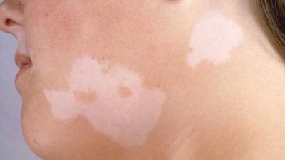 كيف تكون بداية ظهور البهاق؟.. إليكم 3 علامات وأعراض أخرى لظهور المرض