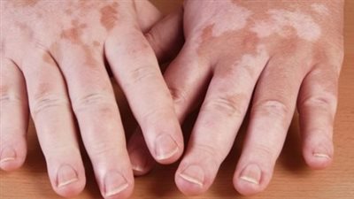 أسباب البهاق المفاجئ.. 5 اضطرابات مناعية تزيد فرص الإصابة بالمرض 