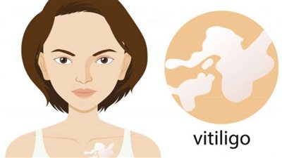 هل مرض البهاق خطير.. 50% من المصابين يعانون مشاكل نفسية