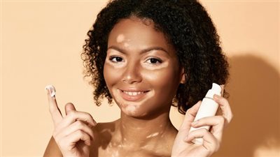 البهاق الخفيف وعلاجه.. يصيب الأطفال ويمكن علاجه بهذه النصائح