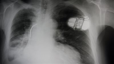 طريقة عمل منظم ضربات القلب لاسلكي خال من البطاريات