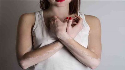 أسباب البهاق النفسية.. الدراسات الطبية تؤكد وجود علاقة تبادلية معقدة 