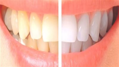 أحذر.. استخدام المواد الحمضية كالليمون أو الفراولة المهروسة لتبييض الأسنان