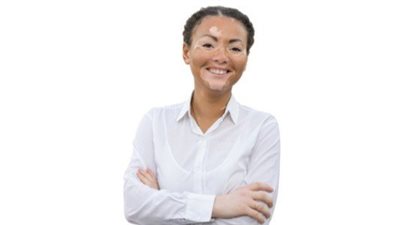 ما هو أفضل علاج لمرض البهاق؟.. معلومات عن الكريمات والجلسات الضوئية