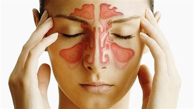 هل التهاب الجيوب الأنفية مرض خطير.. الإهمال يجعله كذلك 