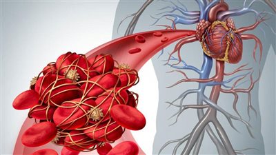 تصلب الشرايين من الأمراض الخطيرة التي تصيب الأوعية الدموية (الأسباب وطرق العلاج)