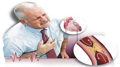 هل الذبحة الصدرية هي الجلطة؟.. نوع انسداد الشريان التاجي يوضح الفرق