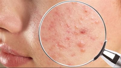 علاج حبوب الشباب.. 5 أدوية موضعية من الصيدلية تُصرف بروشتة