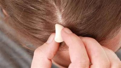 كيف أعالج تساقط الشعر بالثوم؟.. 5 خطوات تعرف عليهم