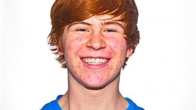 علاج حب الشباب لسن 14 عاما.. 6 نصائح منزلية لعمر المراهقة تحديدًا