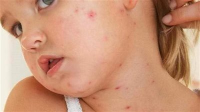 علاج حبوب الشباب للأطفال والرضع.. نصائح مهمة للأمهات