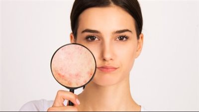 سبب البشرة الدهنية والحبوب.. احذري 5 عوامل محفزة 