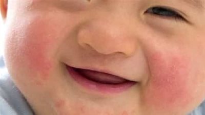 ما سبب ظهور حب الشباب عند الأطفال؟ وما هي العلاجات المتاحة؟