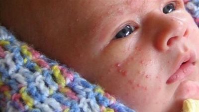 ما هو علاج الحبوب في الوجه عند الأطفال؟.. تعرفي على أسبابها أولا