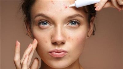 متى يظهر حب الشباب عند البنات؟.. 4 أسباب تؤدي إلى ظهوره